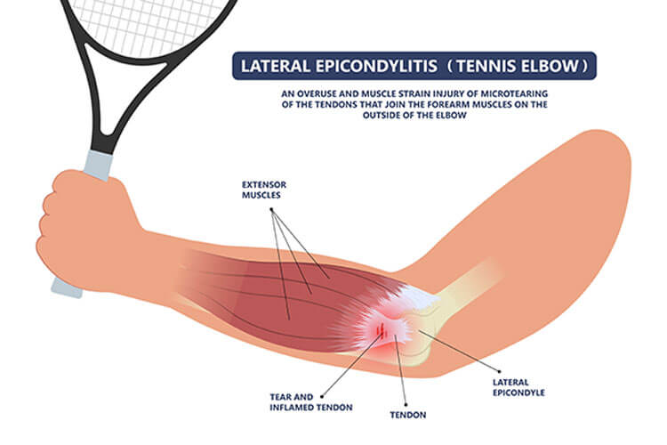 Τι προκαλεί τον αγκώνα του τένις;